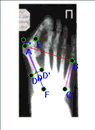 Анализ рентгенограмм на модуле 'Скан'