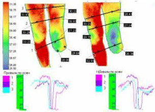 Оценка качества и подгонка приемной гильзы протеза и ортеза по температурной реакции кожных покровов при пользовании изделием